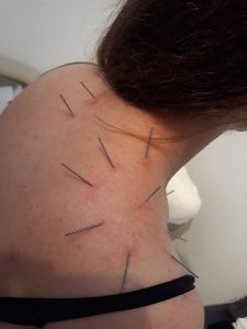 Akupunktur Kronisk Lidelse Akupunktur Huset Valby