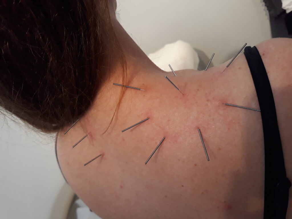 En kvinde der sidder med akupunkturnåle i sin ryg og bliver behandlet med AcuNova