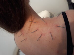 behandlingsmetoder akupunktur