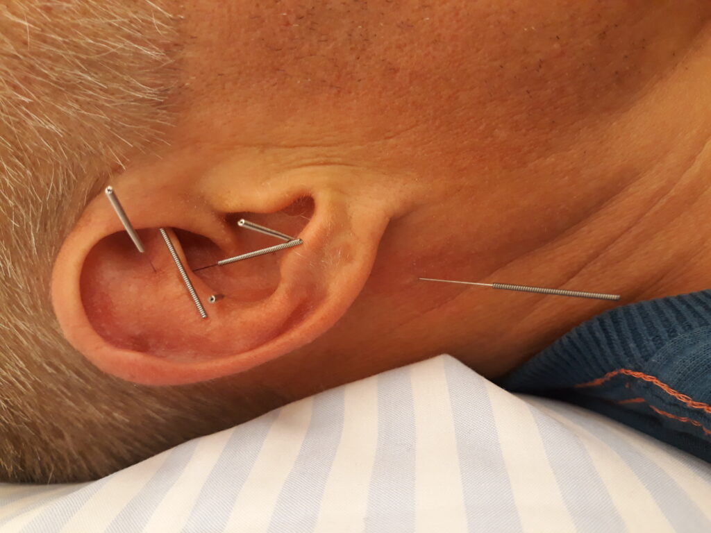 En persons højre øre med akupunkturnåle - Øreakupunktur
