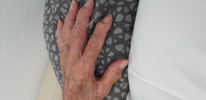 Slidgigt - artrose fingre akupunktur