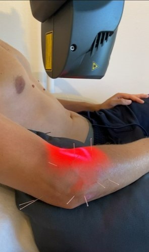 Tennis- / Mus-/ Golfalbue behandlet med laser og akupunktur